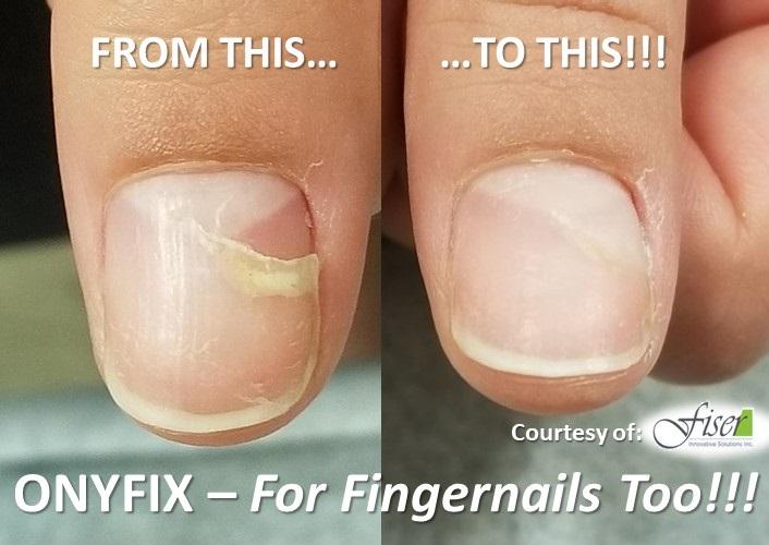 Onyfix products before and after on toenails